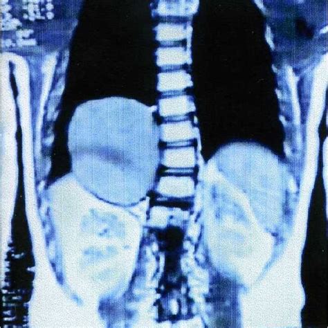 Mri T2 Sequence Cystic Lesion Measuring 7 Cm × 6 Cm And Located Download Scientific Diagram