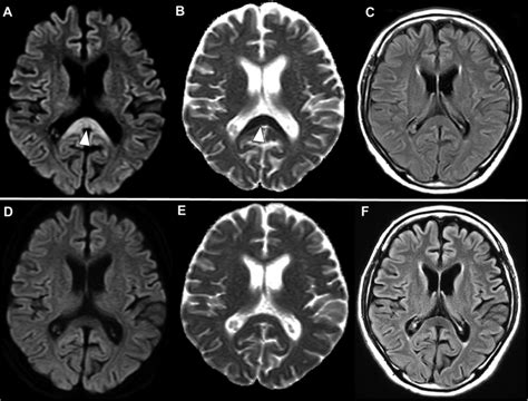 MRI studies of Marchiafava–Bignami disease (a, b, and c). MRI studies ...