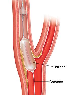 Understanding Carotid Angioplasty And Stenting Saint Luke S Health System