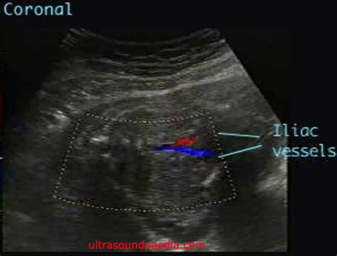 Bilateral renal agenesis – ULTRASOUNDPAEDIA