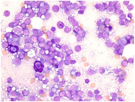 Blurry Vision As A Presentation Of Waldenströms Macroglobulinemia A