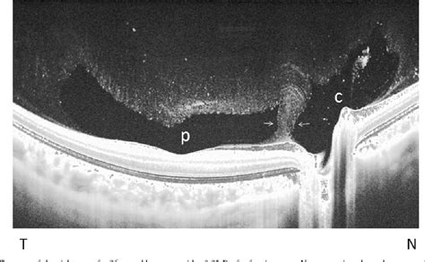 Figure From Anatomy And Pathology Observation Of Posterior