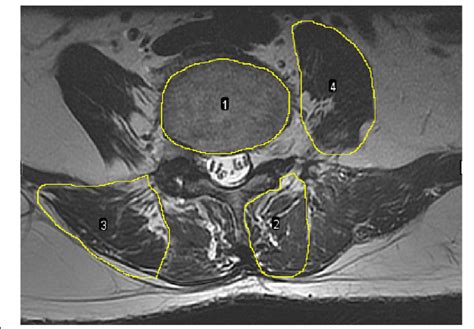 Measurements Of Paraspinal Muscles 1 Vertebral Cross Sectional Area