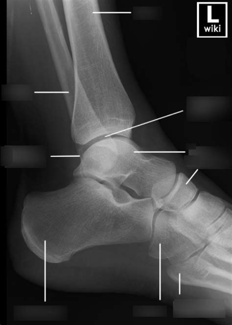 Radr 1411 Mediolateral Ankle Radiograph Diagram Quizlet