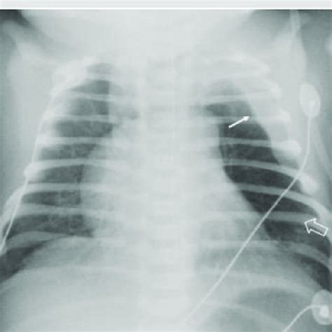 Chest x-ray showing left-sided clavicular fracture. Case courtesy of ...