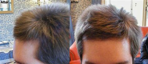 Hairline And Temple Closure Result Fue Alvi Armani Hair Transplant