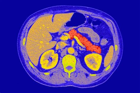 Diabetic pancreas cells made to produce insulin by bone protein | New ...