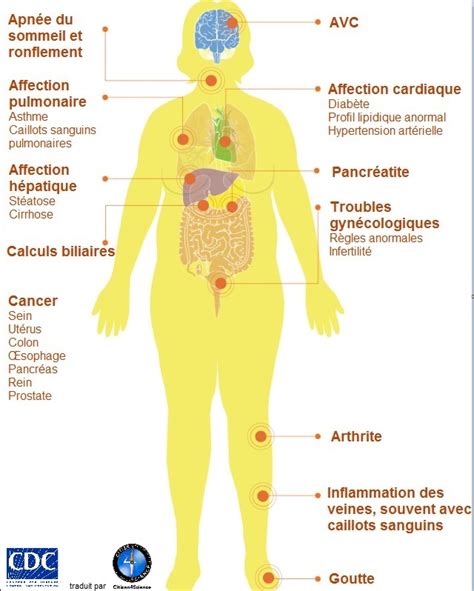 Complication De L Ob Sit Science Infuse Site D Actualit S