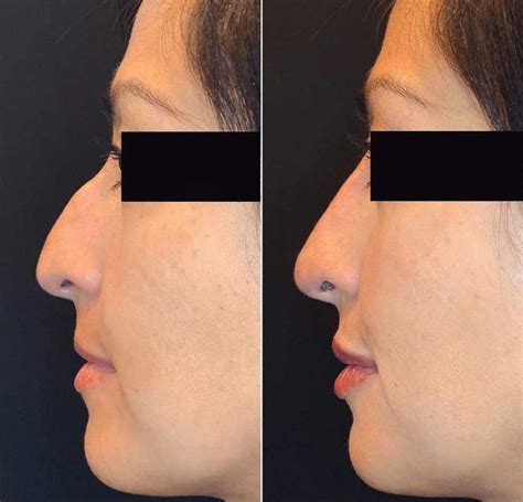 Rhinoplastie médicale ou Rhinofiller Rhinoplastie sans chirurgie