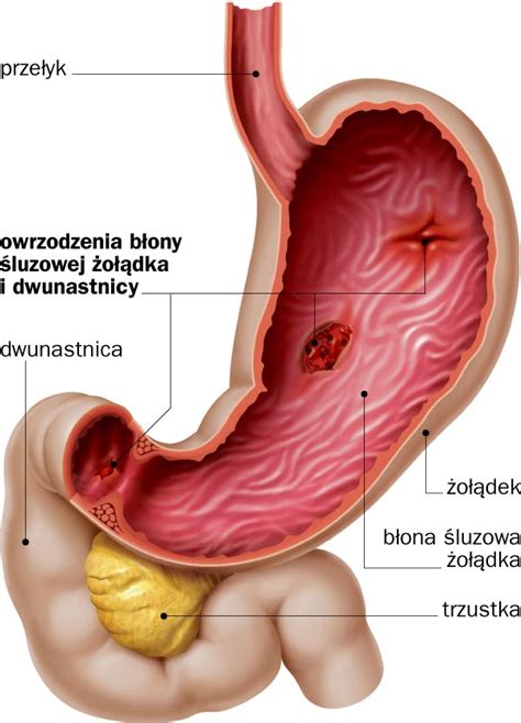 Choroba Wrzodowa Nie Pij Mleka Wasze Zdrowie