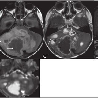 Axial T2W A FLAIR B Axial And Sagittal Post Contrast T1W C And