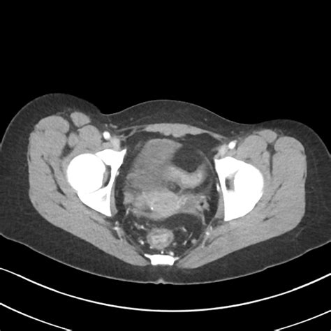 Radiopaedia Case Ulcerative Colitis Id 47644 Study 52306 NC Commons