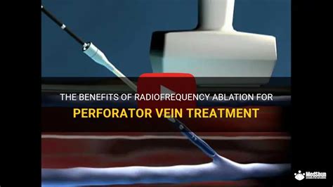 The Benefits Of Radiofrequency Ablation For Perforator Vein Treatment