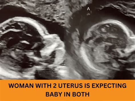 Woman With 2 Uterus Is Expecting Baby In Both In 1 In A Million