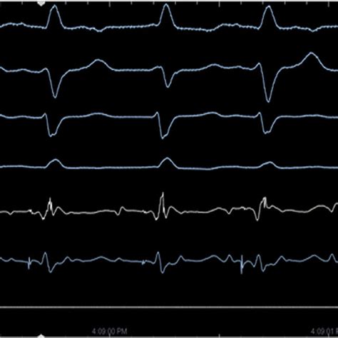 Surface Electrocardiogram As Well As Intracardiac Electrogram