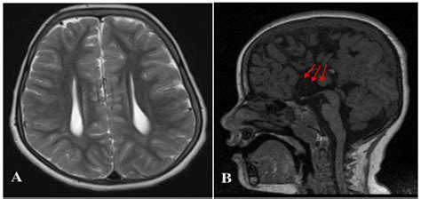 (A and B): Struge Weber syndrome in a 9-year-old male patient... | Download Scientific Diagram