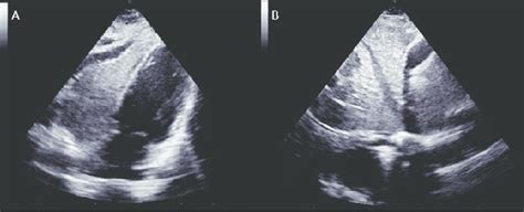 Transthoracic echocardiography, subcostal view. Spontaneous echo ...