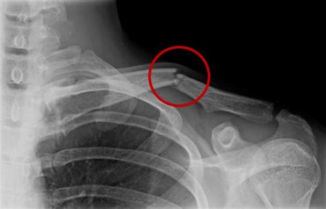 Slingeland Ziekenhuis Patiëntfolder Broken Collarbone In Adults