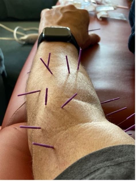 Dry Needling Joint Manipulation For Golf Tennis Elbow Medial