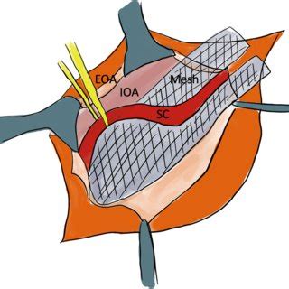 Two Main Laparoscopic Approaches To Hernial Repair Are Illustrated