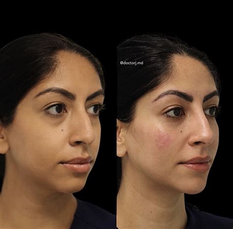 Chin Enhancement Filler Treatment Vancouver One Clinic Md