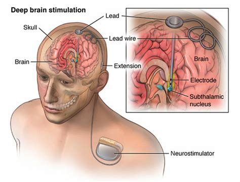 How Is The Deep Brain Stimulator System Implanted Jagtap Clinic And Research Centre