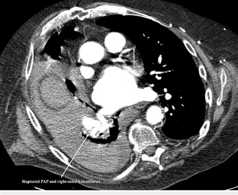 Cta Chest Showing Right Lower Lobe Pulmonary Artery Pseudoaneurysm And Download Scientific