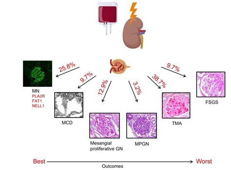 Ckj On Twitter Glomerular Diseases Post Hematopoietic Stem Cell