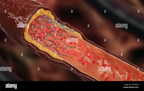 3D Darstellung Der Angioplastie Stent Wird In Einer Erkrankten Arterie