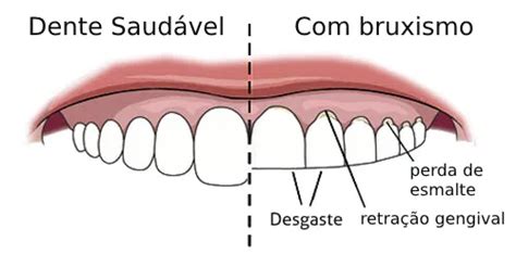 Bruxismo O que é Causas Sintomas e Tratamentos