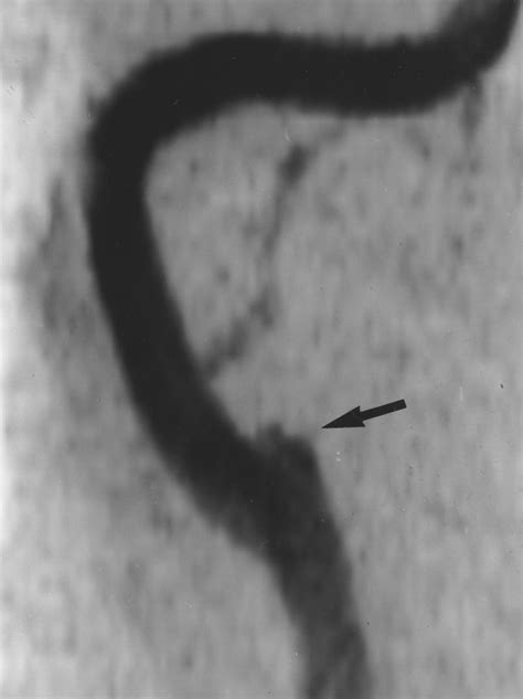 Mr Angiography For The Long Term Follow Up Of Dissecting Aneurysms Of