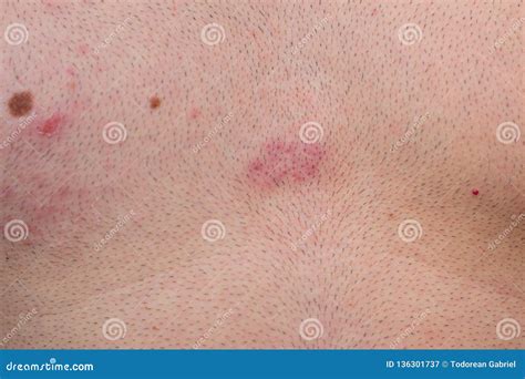 Herpes Zoster Eine Schmerzliche Krankheit Stockbild Bild Von