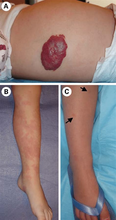 Vascular Tumors And Malformations A Proliferating Hemangioma A Download Scientific Diagram