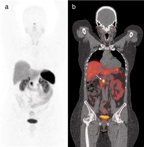 Ga Dotatate Pet Ct Results A Anterior Mip B Coronal Fusion In A