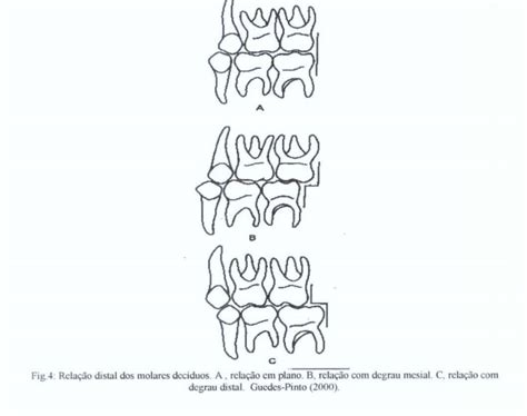 Oclusão Normal na Dentição Decídua VIAGEM PELA ORTODONTIA