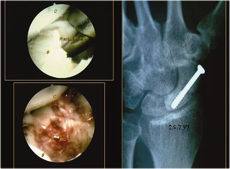 Revolutions In Arthroscopic Wrist Surgeries Toshiyasu Nakamura Pak