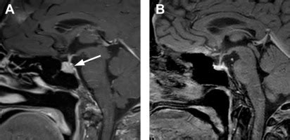 Pituitary Gland Mri