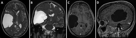 Enlarging Symptomatic Arachnoid Cyst In An Elderly Patient