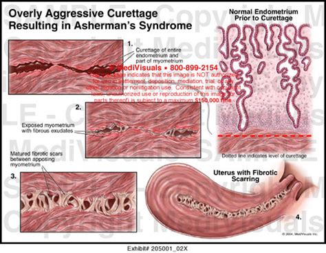 Asherman Syndrome Pictures