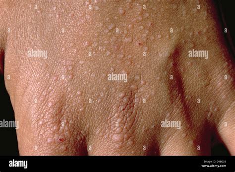 Papular Rash Stock Photo Alamy