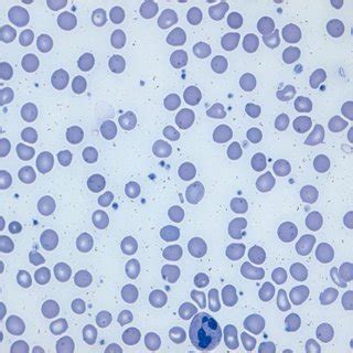 Peripheral Blood Smear Shows Hypersegmented Neutrophils And Normocytic