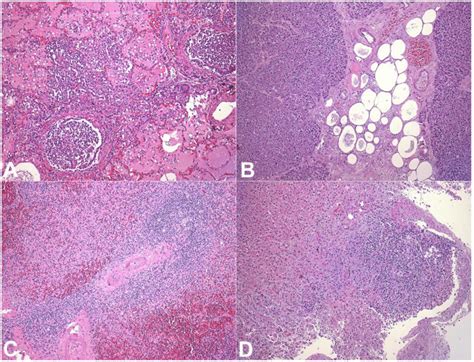 Photomicrographs A Lung Pulmonary Parenchyma Showing Bronchopneumonia Download Scientific