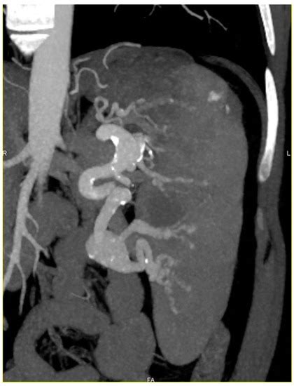 What Causes A Splenic Artery Aneurysm To Rupture - mapasgmaes