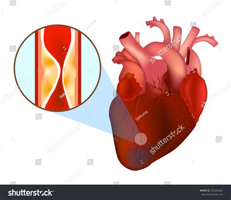 Blocked Arteries Heart Attack Myocardial Infarction Stockvector