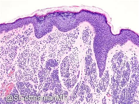 Epidermodysplasia Verruciformis Incidental