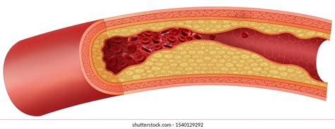 Arteriosclerosis Disease Accumulation Cholesterol Fats Walls 스톡 일러스트