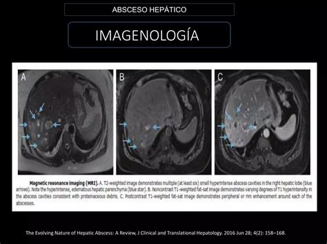 Absceso Hep Tico Piogeno Y Amebiano Ppt