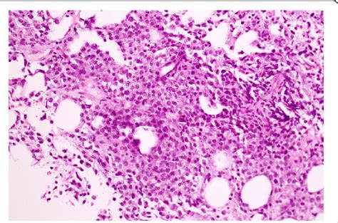 Lymph Node Core Biopsy With Hematoxylin And Eosin Stain Showing