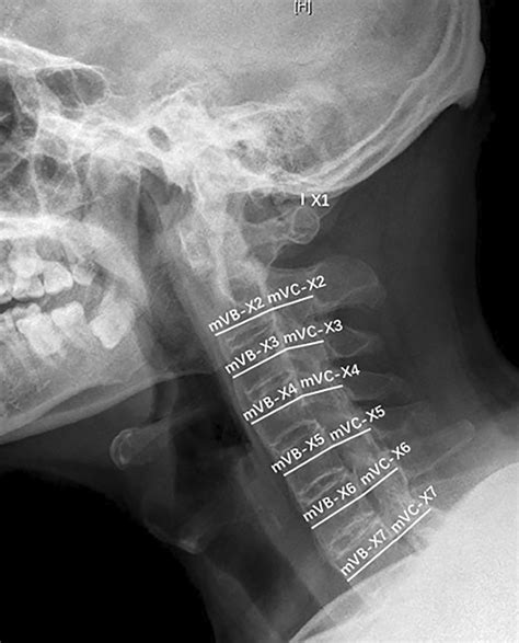 Distance Measurement On The Lateral Cervical X‐ray In The Neutral