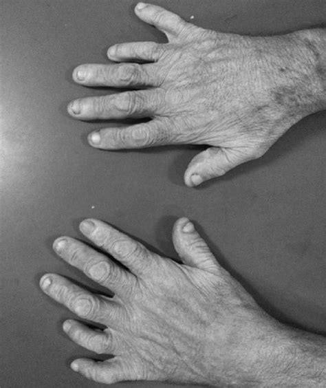 Polydactyly Of Case 1 Download Scientific Diagram